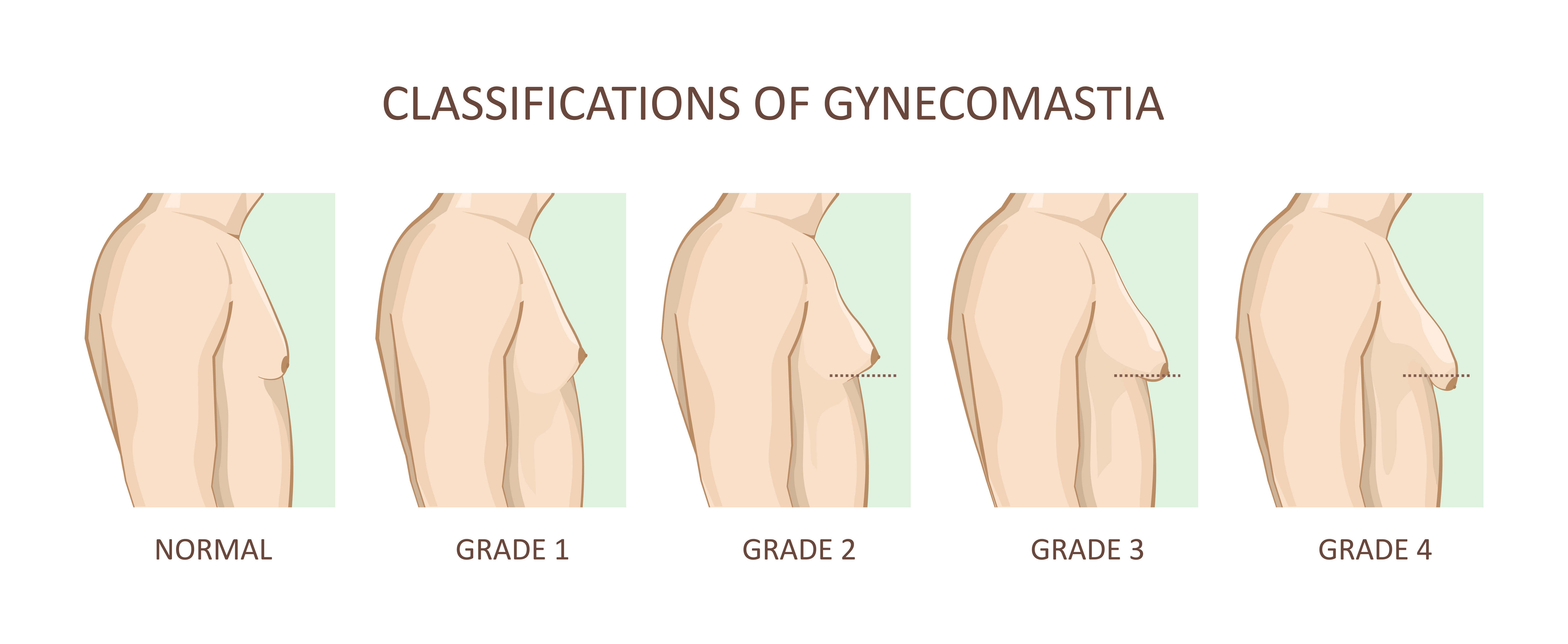 Varying grades of gynecomastia